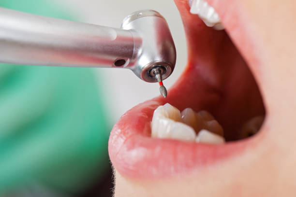 Best Emergency Tooth Extraction in Agua Dulce, CA